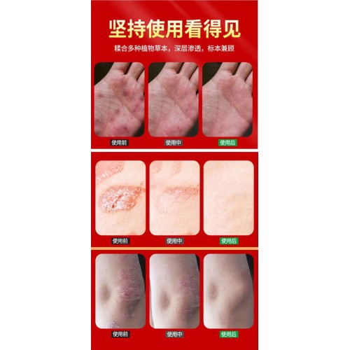 泰国拔毒顽痒清 50g x 3瓶