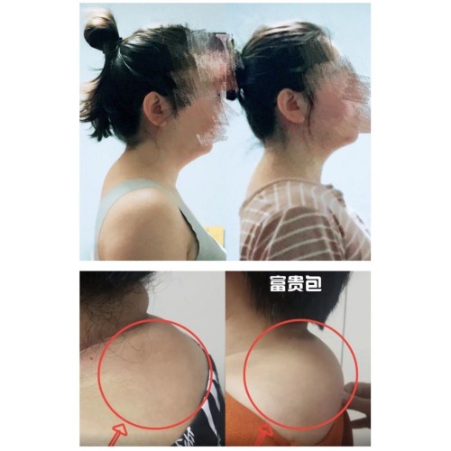 走珠型氨糖软骨素富贵包舒缓液2瓶
