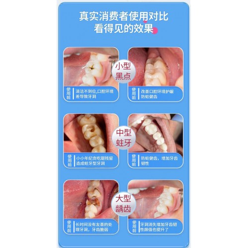 奢露华蜂毒多肽口腔抑菌膏120g*6支